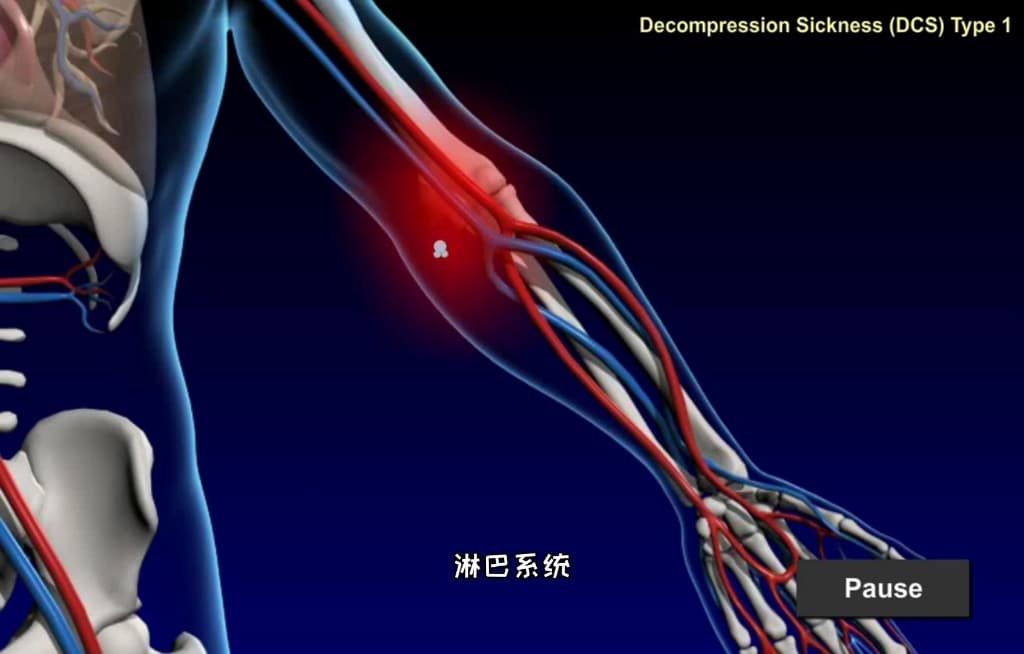 自由潜水技巧视频解析：潜水造成减压病原因，3D演示。。
